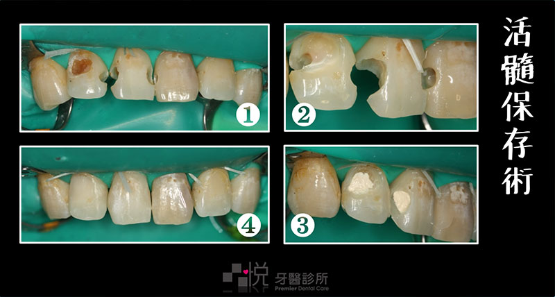 活髓保存術